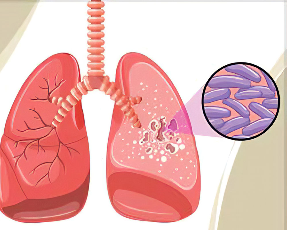 Tuberculosis-and-Leprosy-Program-Management-Short-Course-1