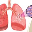 Tuberculosis and Leprosy Program Management Short Course