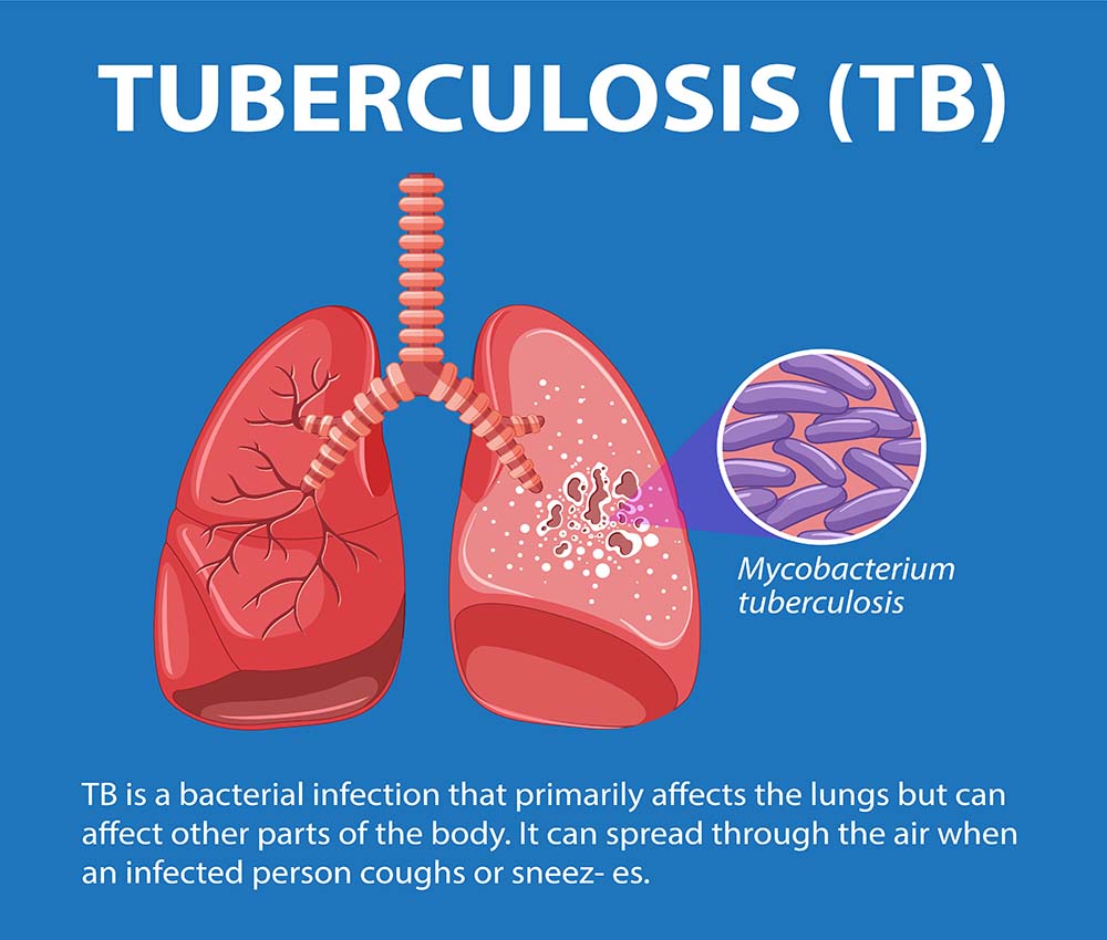 Human Anatomy of Lung with Tuberculosis Infographic